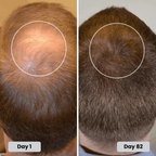 Red Light Therapy for Hair Fast Growth Cap