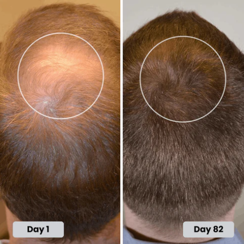Red Light Therapy for Hair Fast Growth Cap