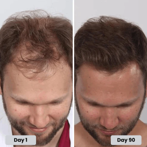 Red Light Therapy for Hair Fast Growth Cap