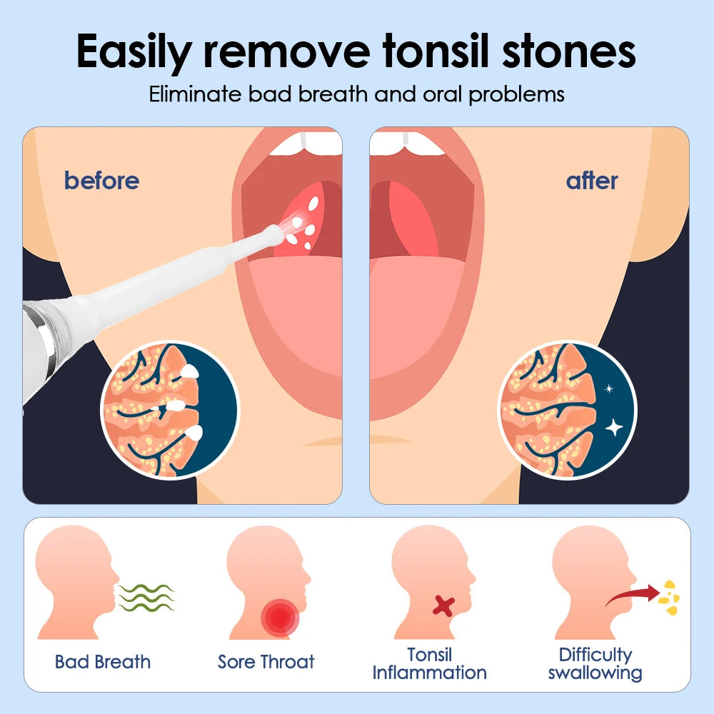 Pilore Electric Tonsil Stone Remover Tool